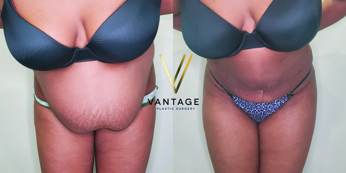 before and after Abdominoplasty