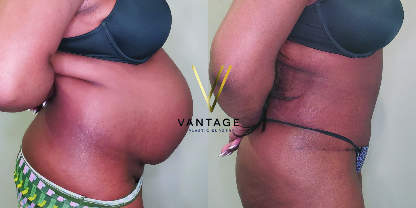 before and after Abdominoplasty