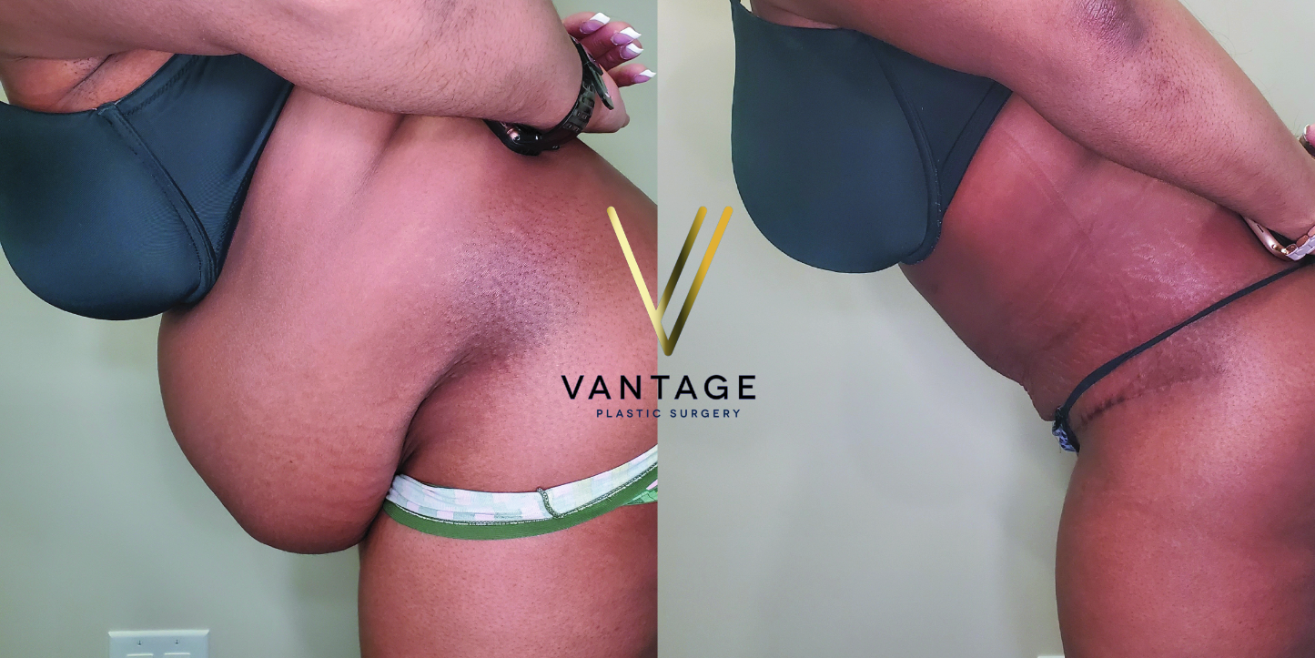 before and after Abdominoplasty