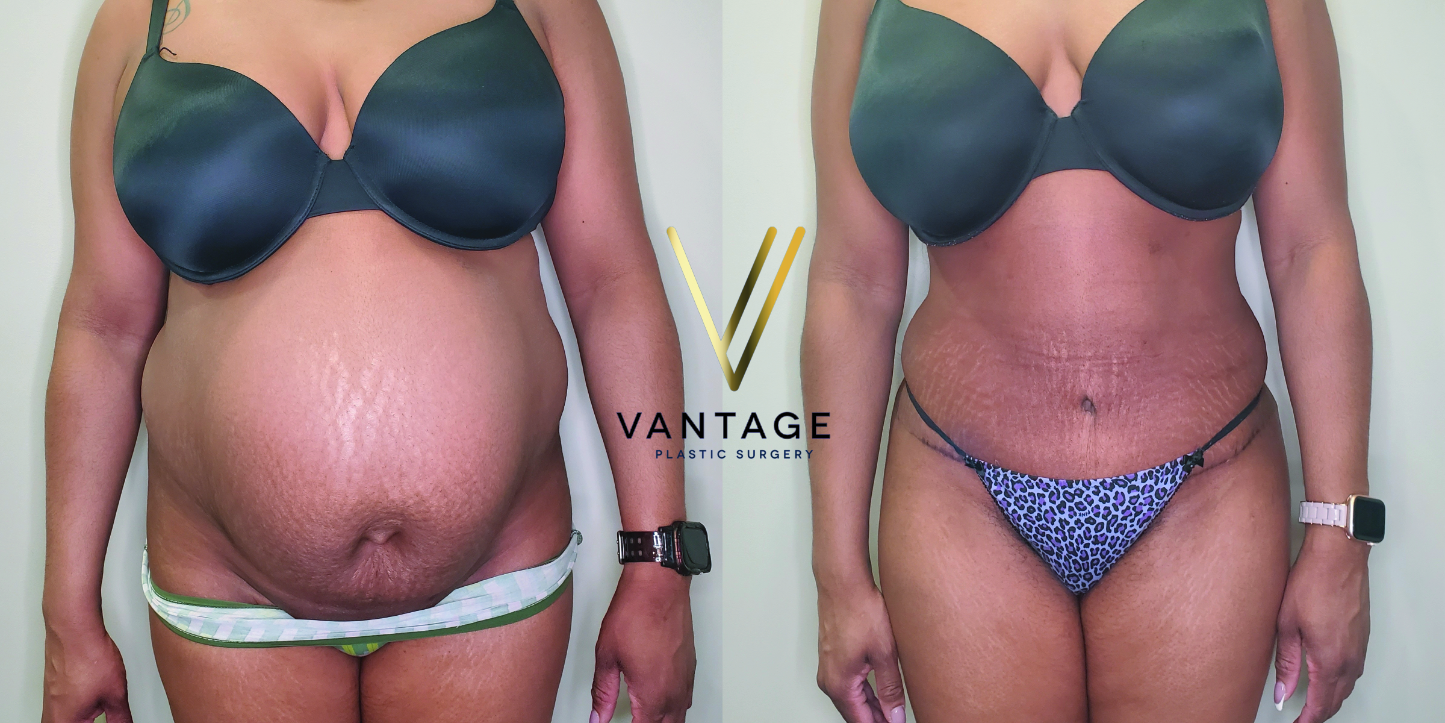 before and after Abdominoplasty