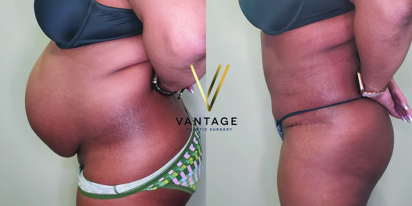 before and after Abdominoplasty