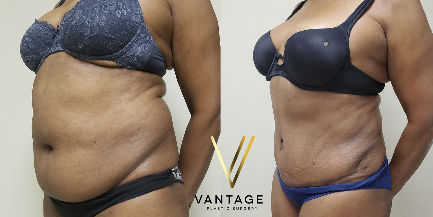 before and after Abdominoplasty