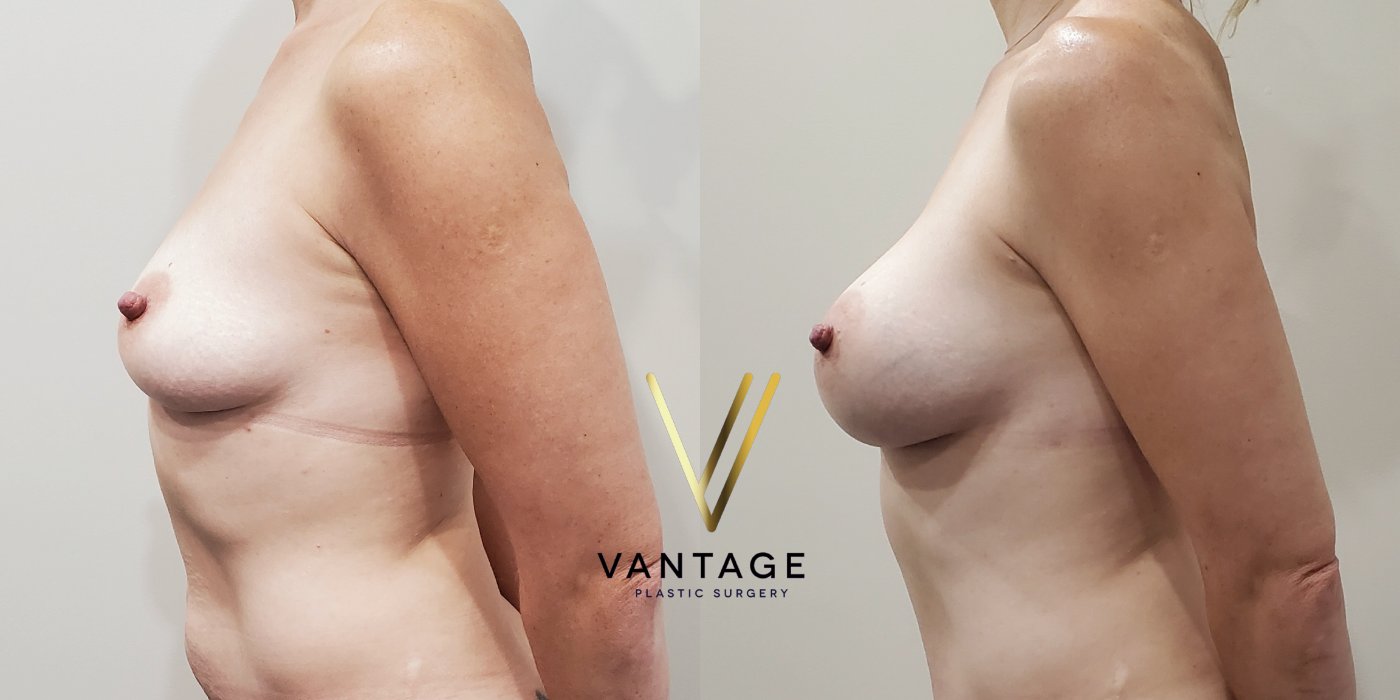 Breast Augmentation before and after photo