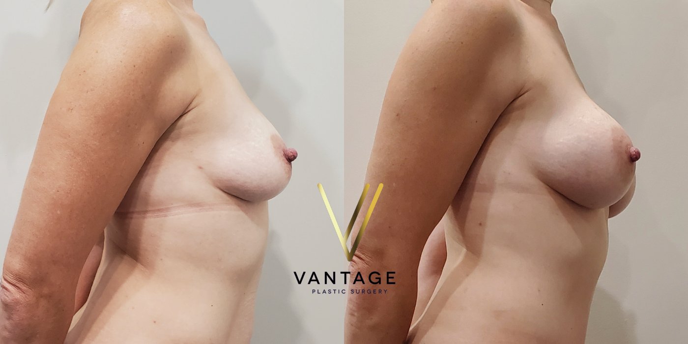 Breast Augmentation before and after photo
