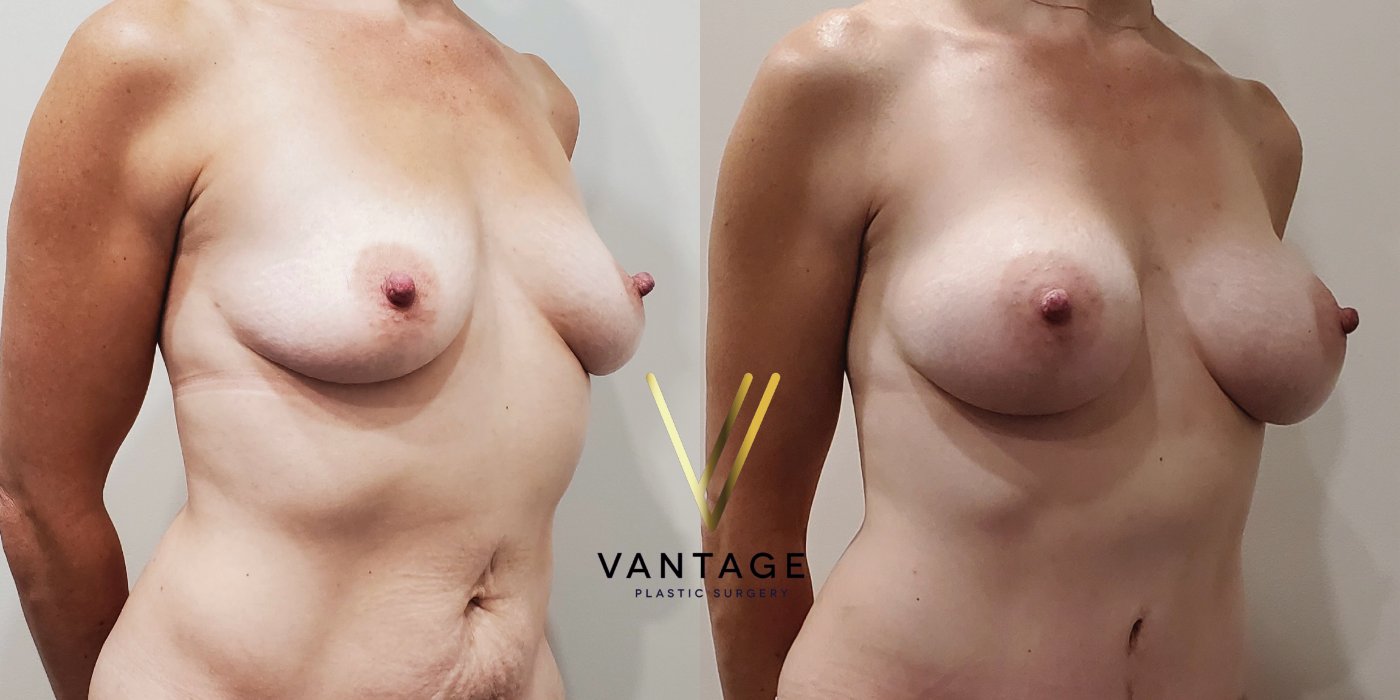 Breast Augmentation before and after photo