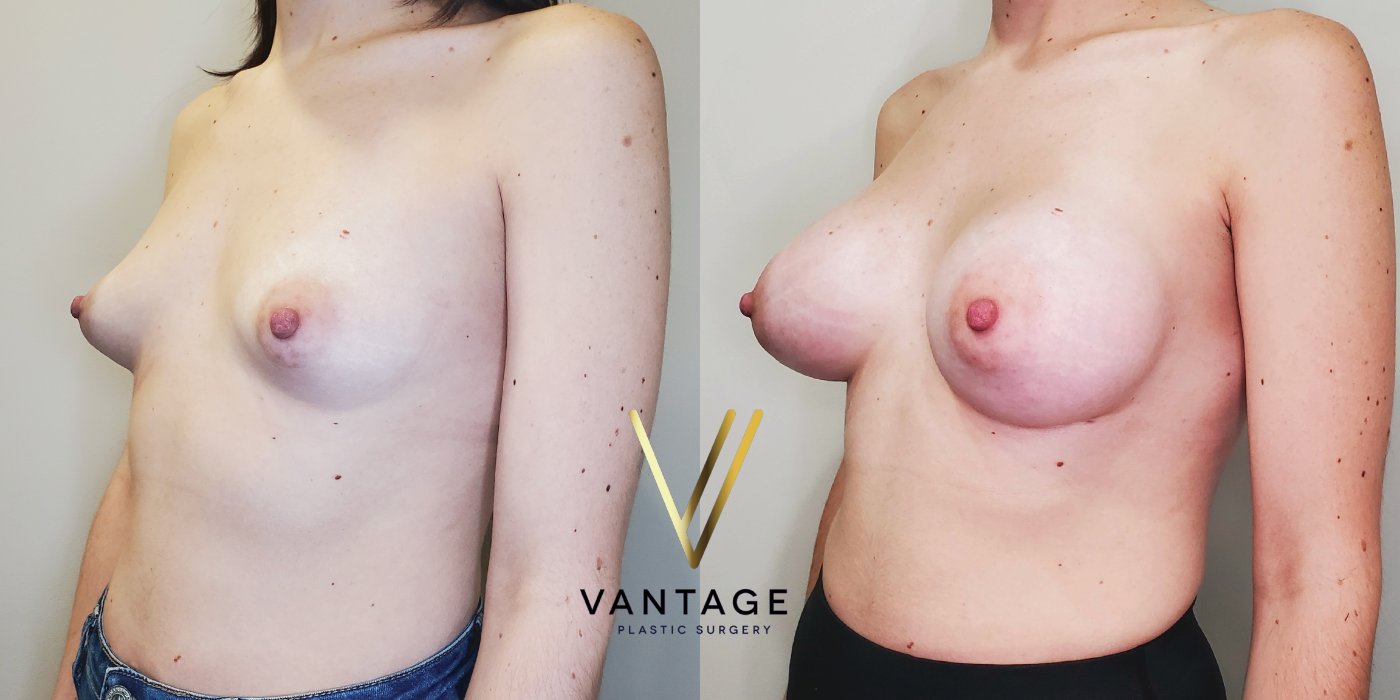 Breast Augmentation before and after photo