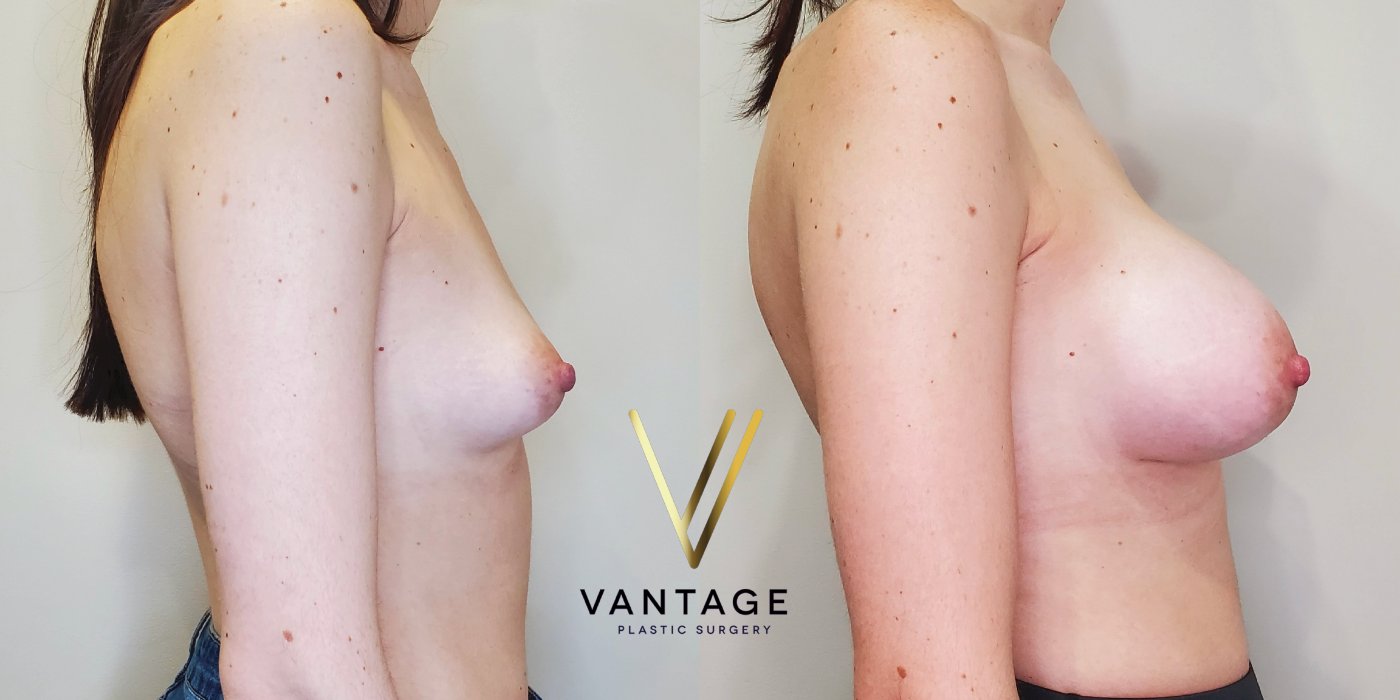 Breast Augmentation before and after photo