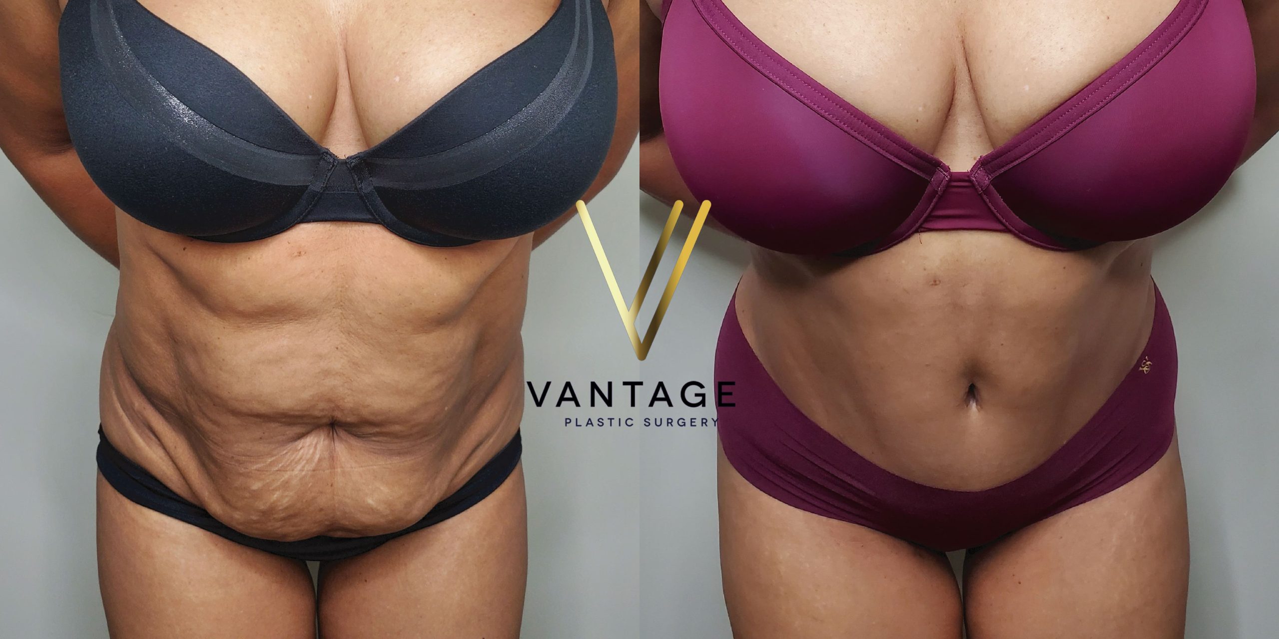 before and after Abdominoplasty