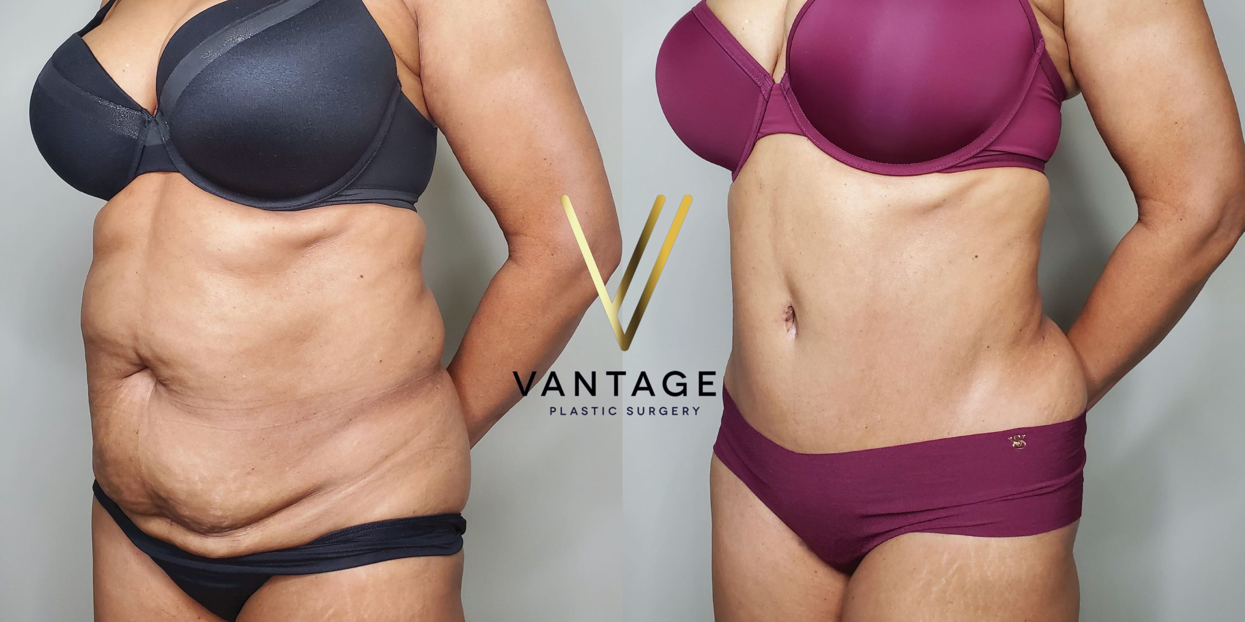 before and after Abdominoplasty