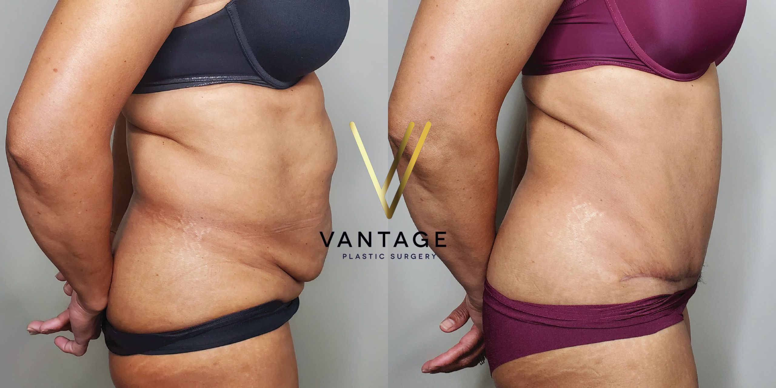 before and after Abdominoplasty