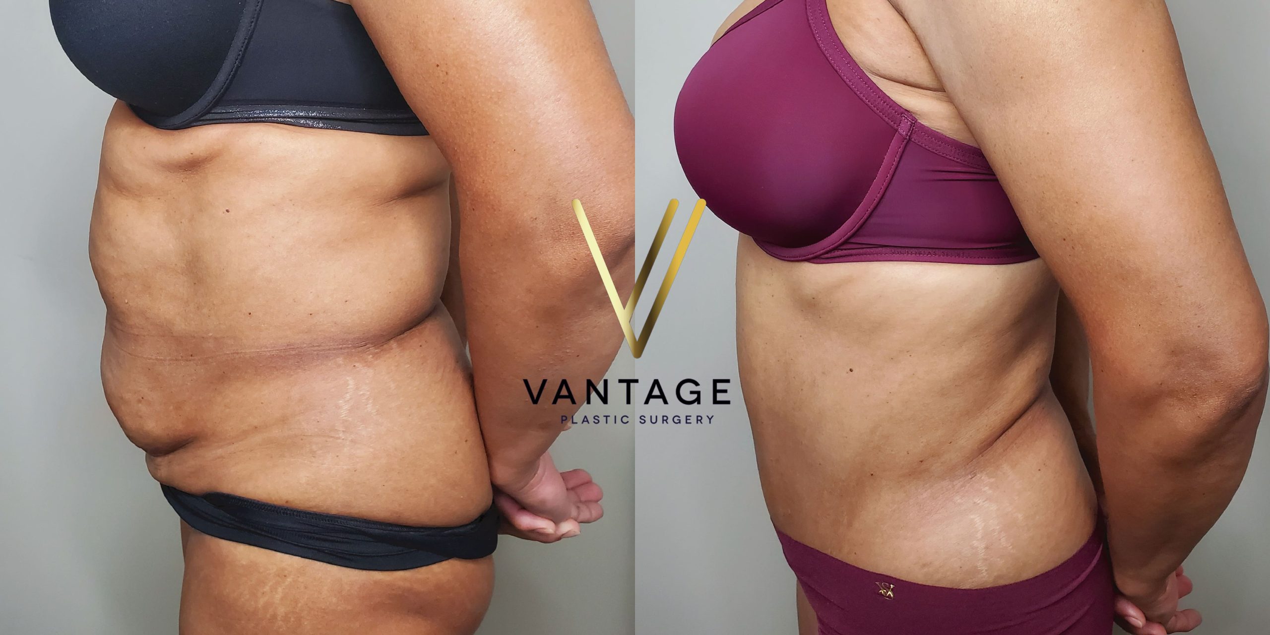 before and after Abdominoplasty