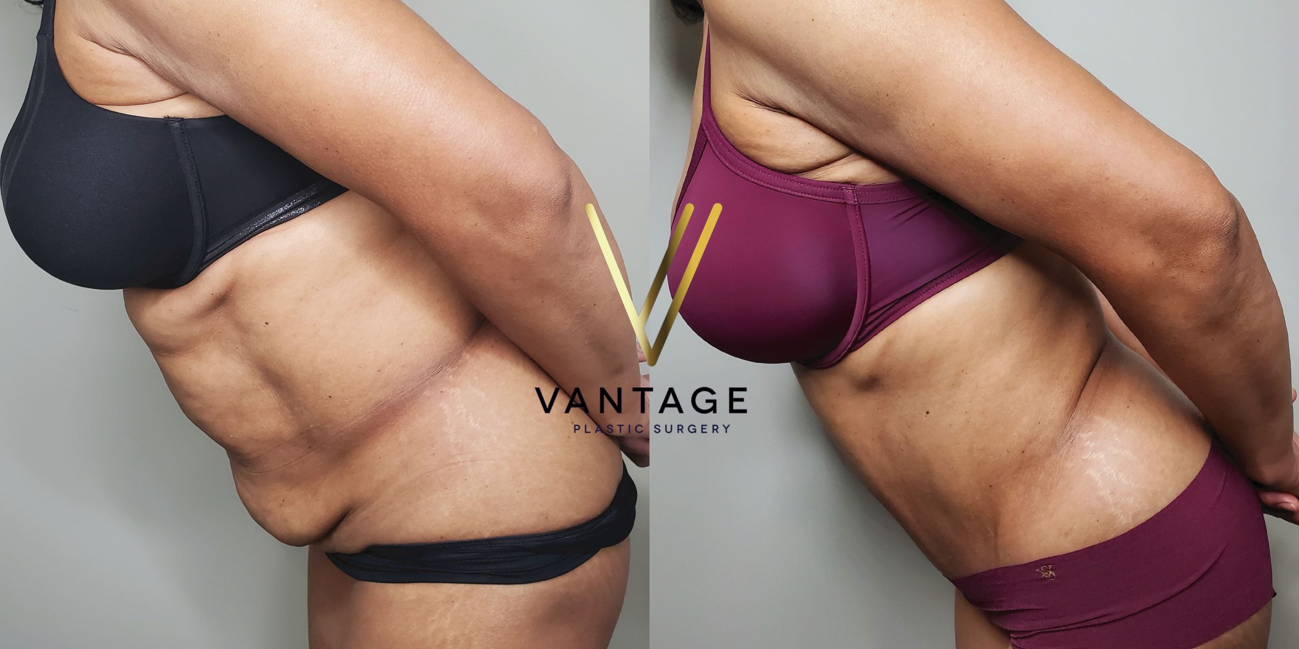 before and after Abdominoplasty