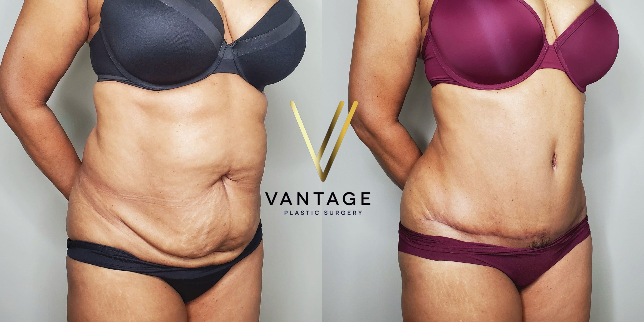 before and after Abdominoplasty