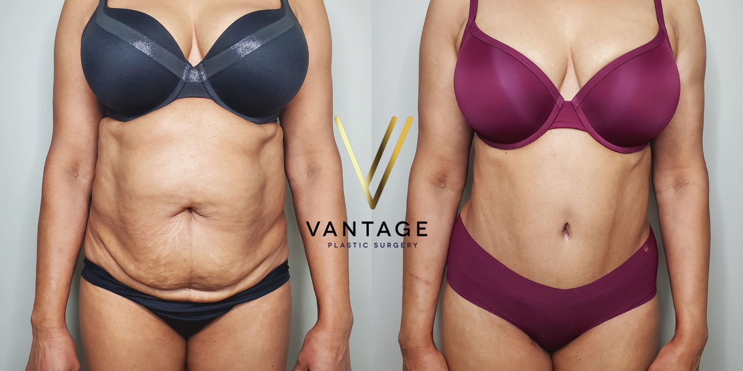 before and after Abdominoplasty