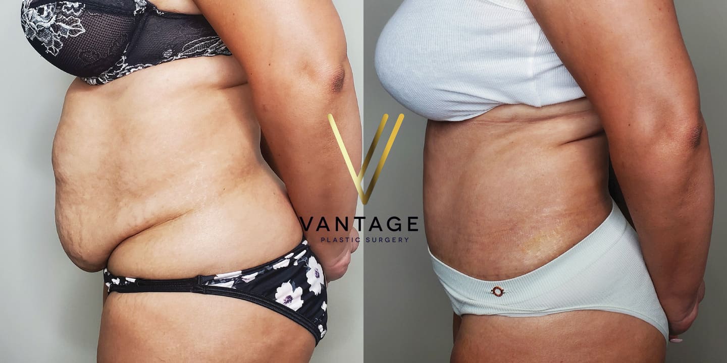 before and after Abdominoplasty