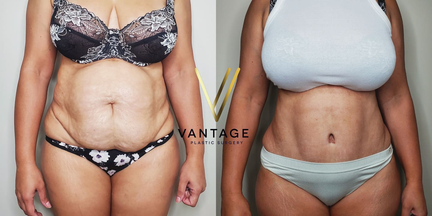 before and after Abdominoplasty