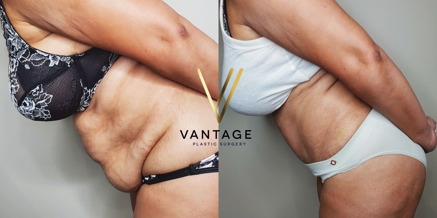 before and after Abdominoplasty