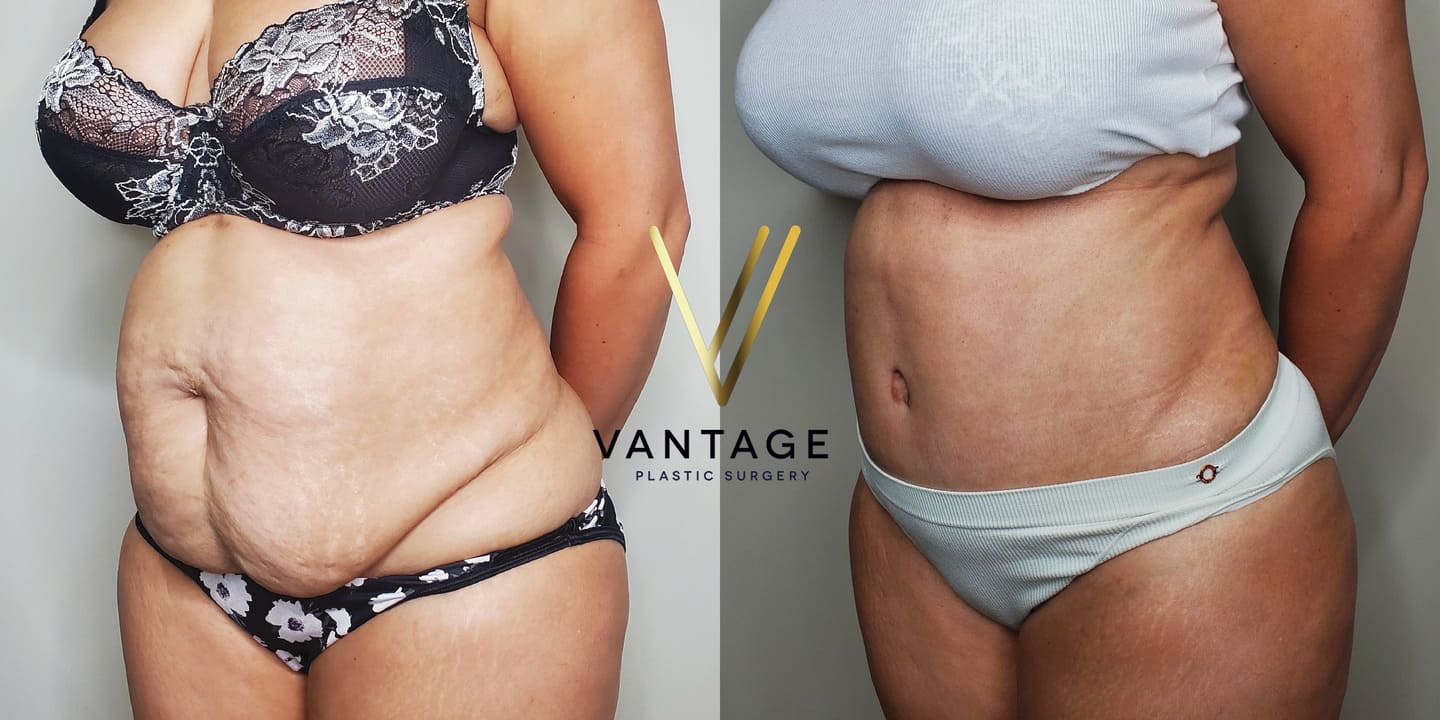 before and after Abdominoplasty