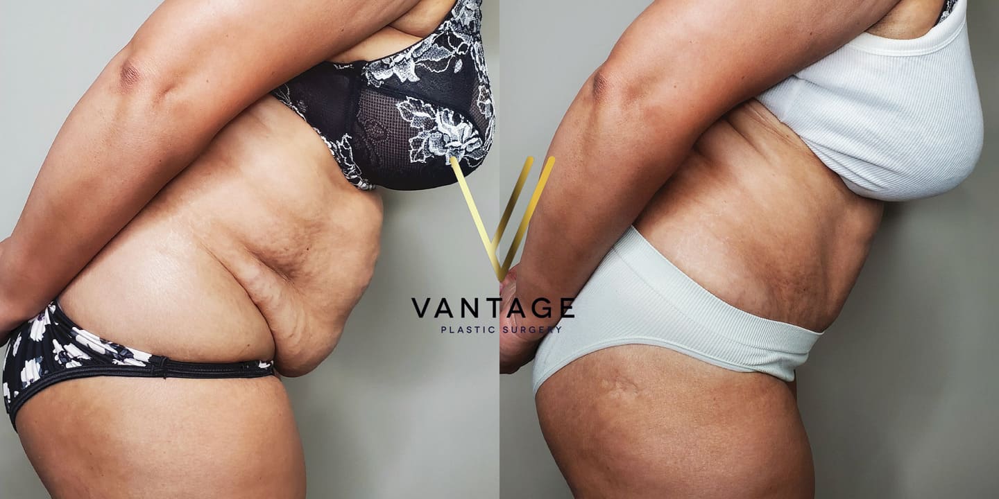 before and after Abdominoplasty