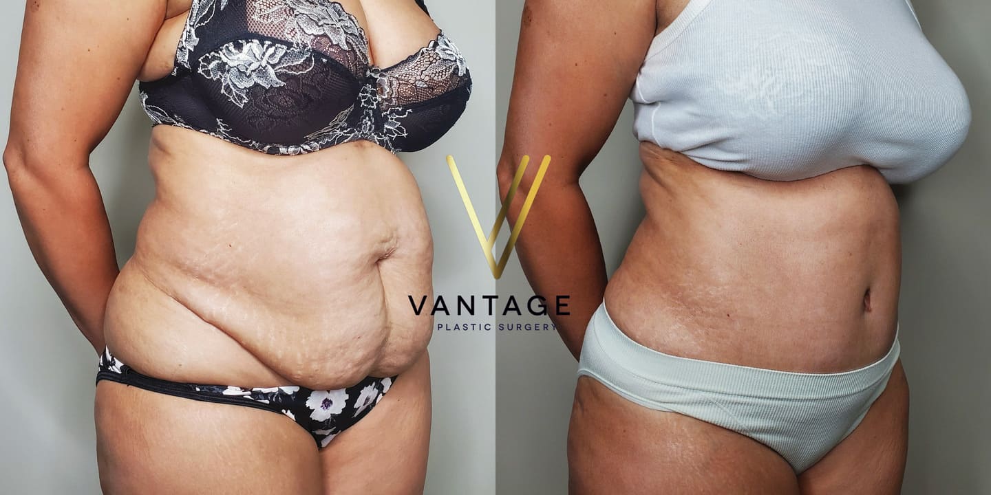 before and after Abdominoplasty