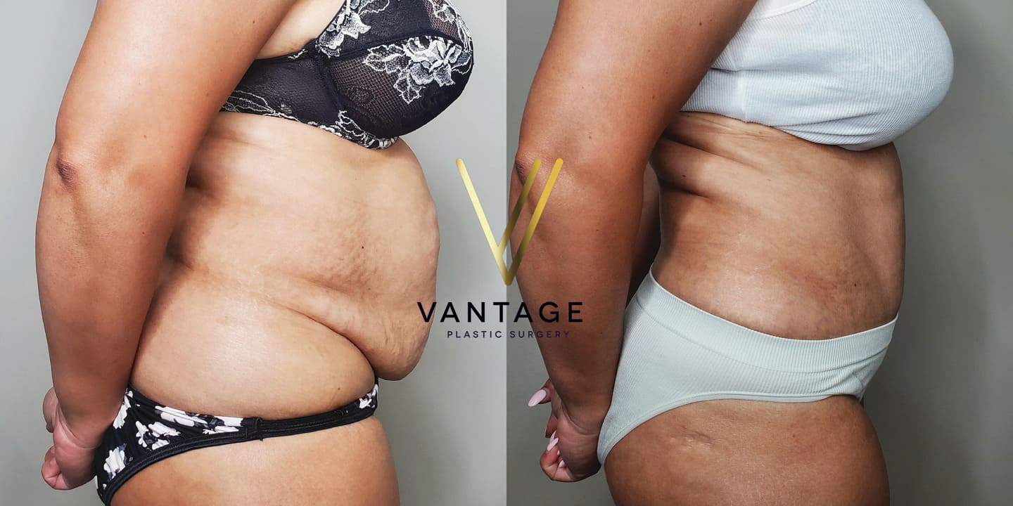 before and after Abdominoplasty