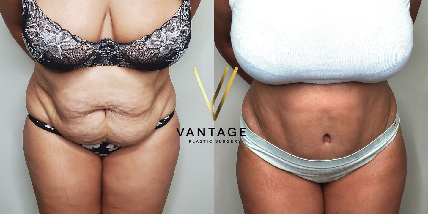 before and after Abdominoplasty