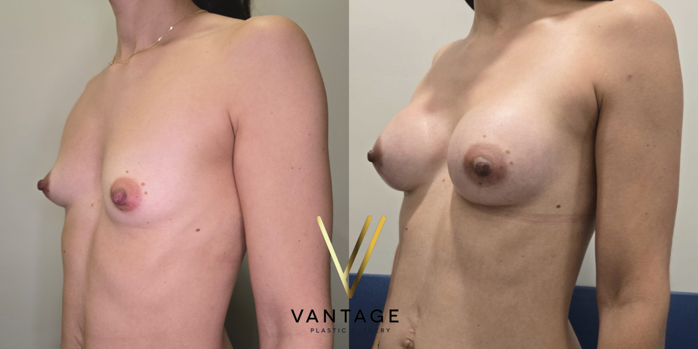 The image shows the results of a breast augmentation procedure — a before and after view of a patient treated at Vantage Plastic Surgery. Improved breast volume and shape. Left Oblique view.