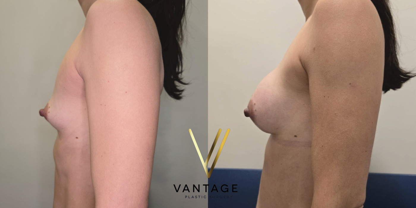 The image shows the results of a breast augmentation procedure — a before and after view of a patient treated at Vantage Plastic Surgery. Improved breast volume and shape. Left Side.