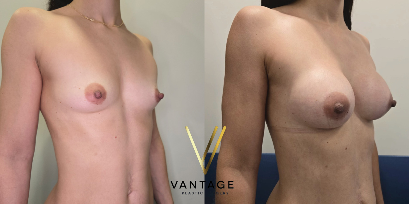 The image shows the results of a breast augmentation procedure — a before and after view of a patient treated at Vantage Plastic Surgery. Improved breast volume and shape. Right Oblique view.