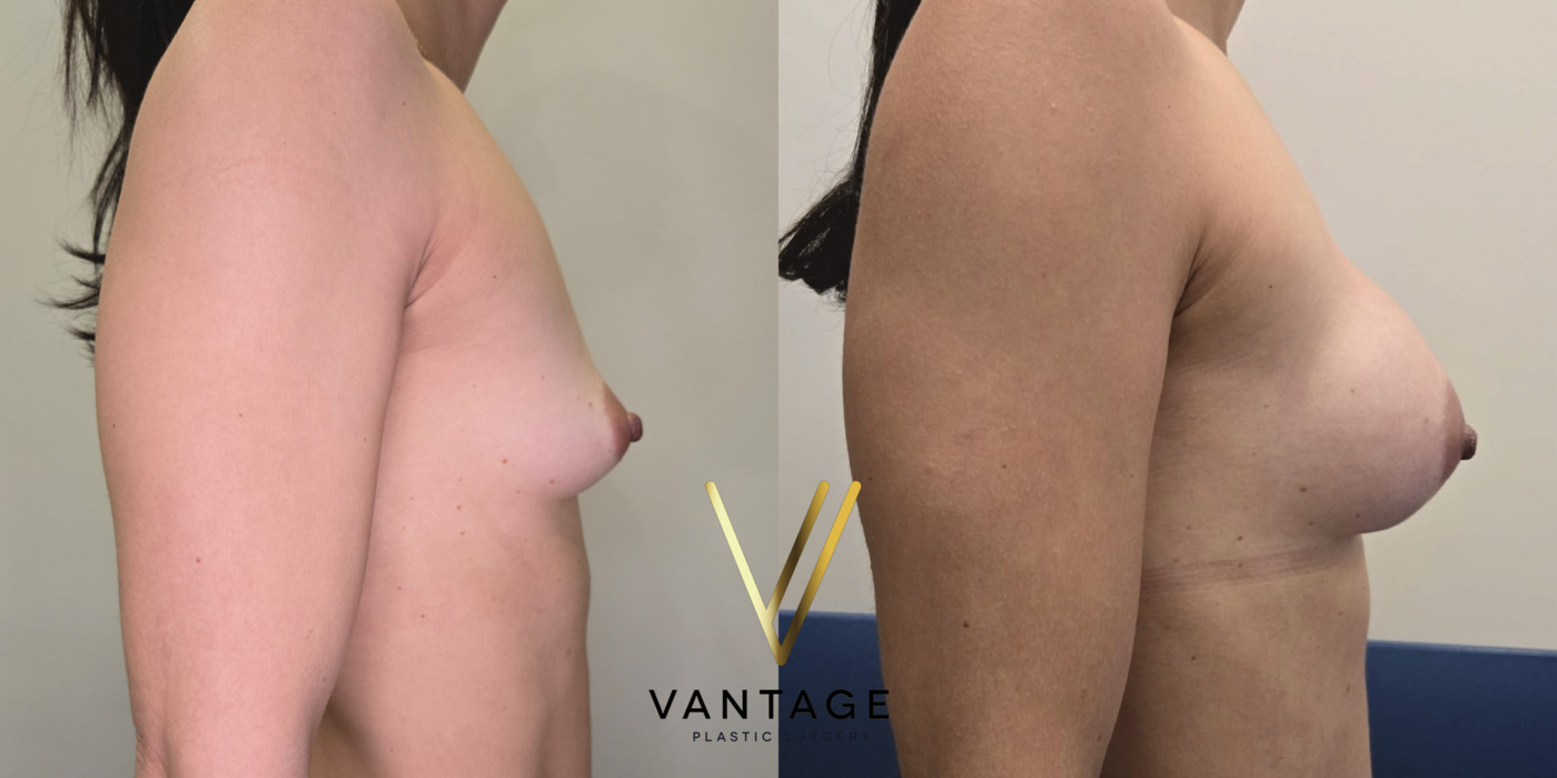 The image shows the results of a breast augmentation procedure — a before and after view of a patient treated at Vantage Plastic Surgery. Improved breast volume and shape. Right Side.