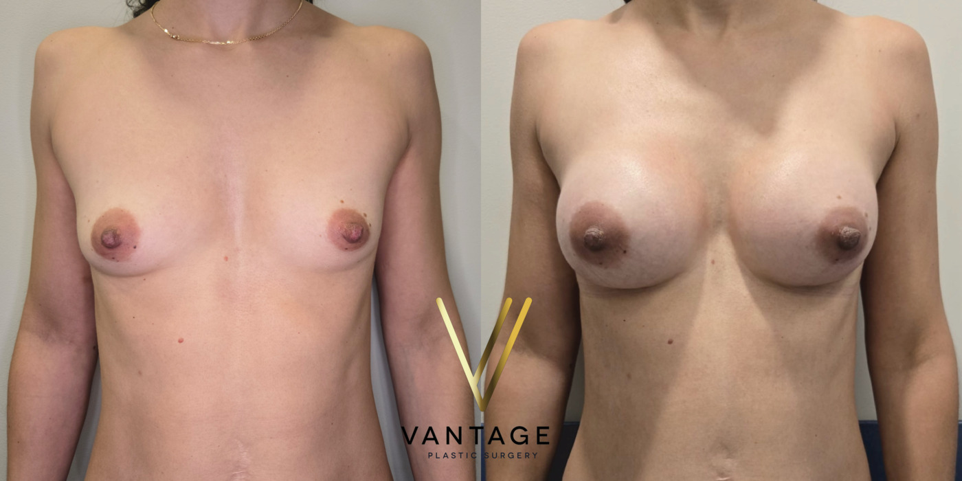 The image shows the results of a breast augmentation procedure — a before and after view of a patient treated at Vantage Plastic Surgery. Improved breast volume and shape. Front.