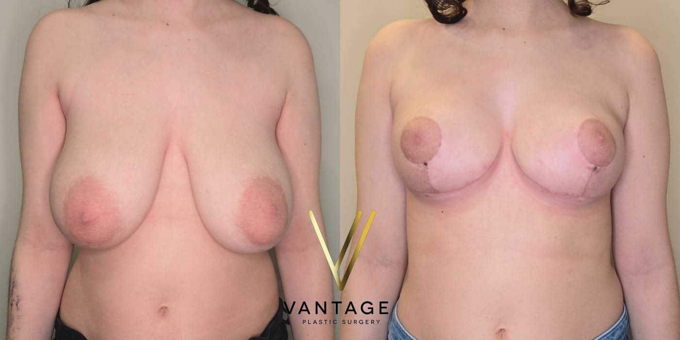 Before and after image of internal bra breast reduction procedure, front view, performed at Vantage Plastic Surgery.