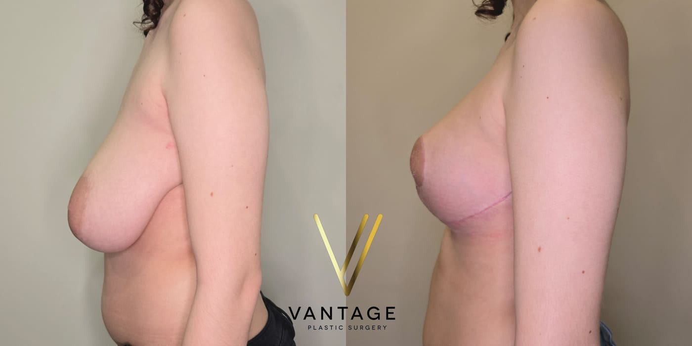 Before and after image of internal bra breast reduction procedure, left view, performed at Vantage Plastic Surgery.