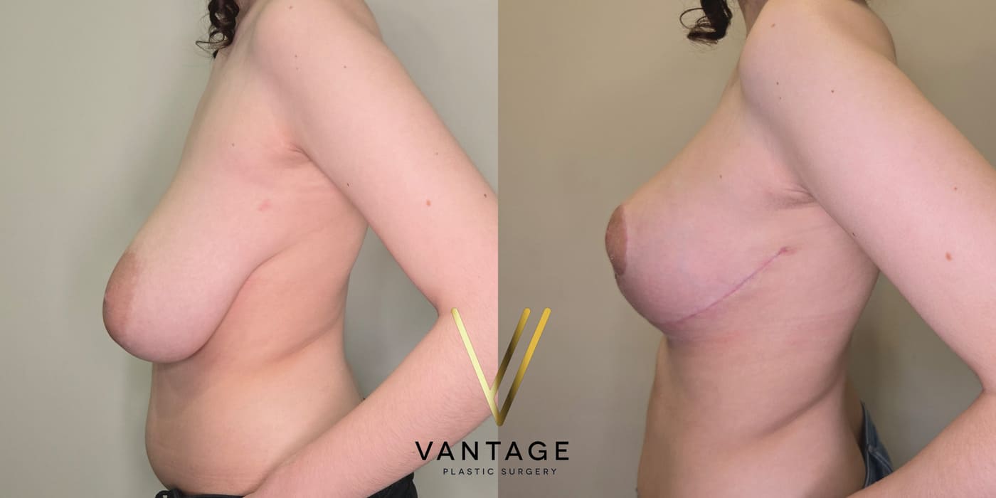 Before and after image of internal bra breast reduction procedure, left view, performed at Vantage Plastic Surgery.