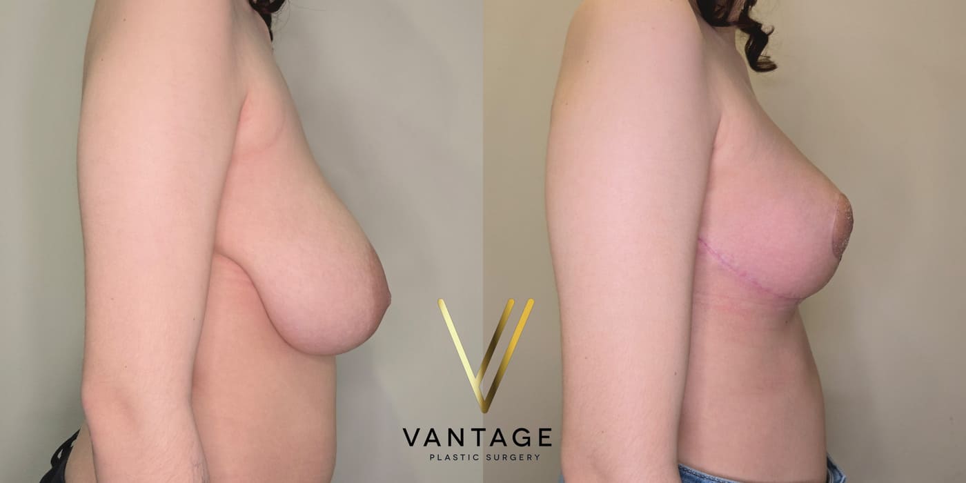 Before and after image of internal bra breast reduction procedure, right view, performed at Vantage Plastic Surgery.