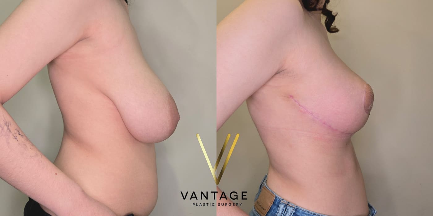 Before and after image of internal bra breast reduction procedure, right view, performed at Vantage Plastic Surgery.