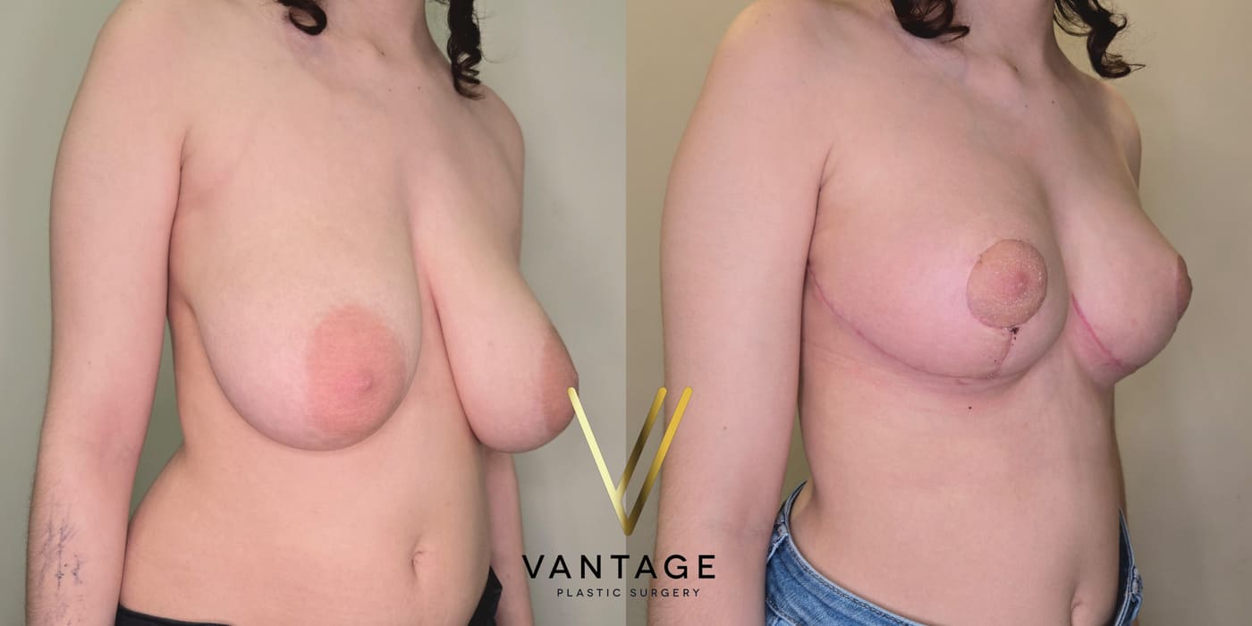 Before and after image of internal bra breast reduction procedure, right oblique view, performed at Vantage Plastic Surgery.