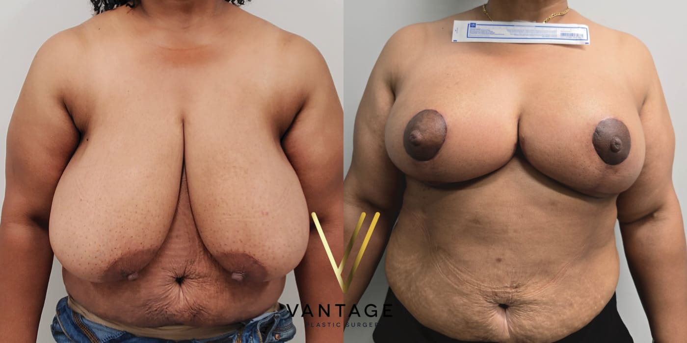 Before and after image of internal bra breast reduction procedure, front view, performed at Vantage Plastic Surgery.