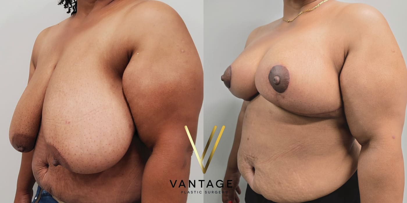 Before and after image of internal bra breast reduction procedure, left oblique view, performed at Vantage Plastic Surgery.