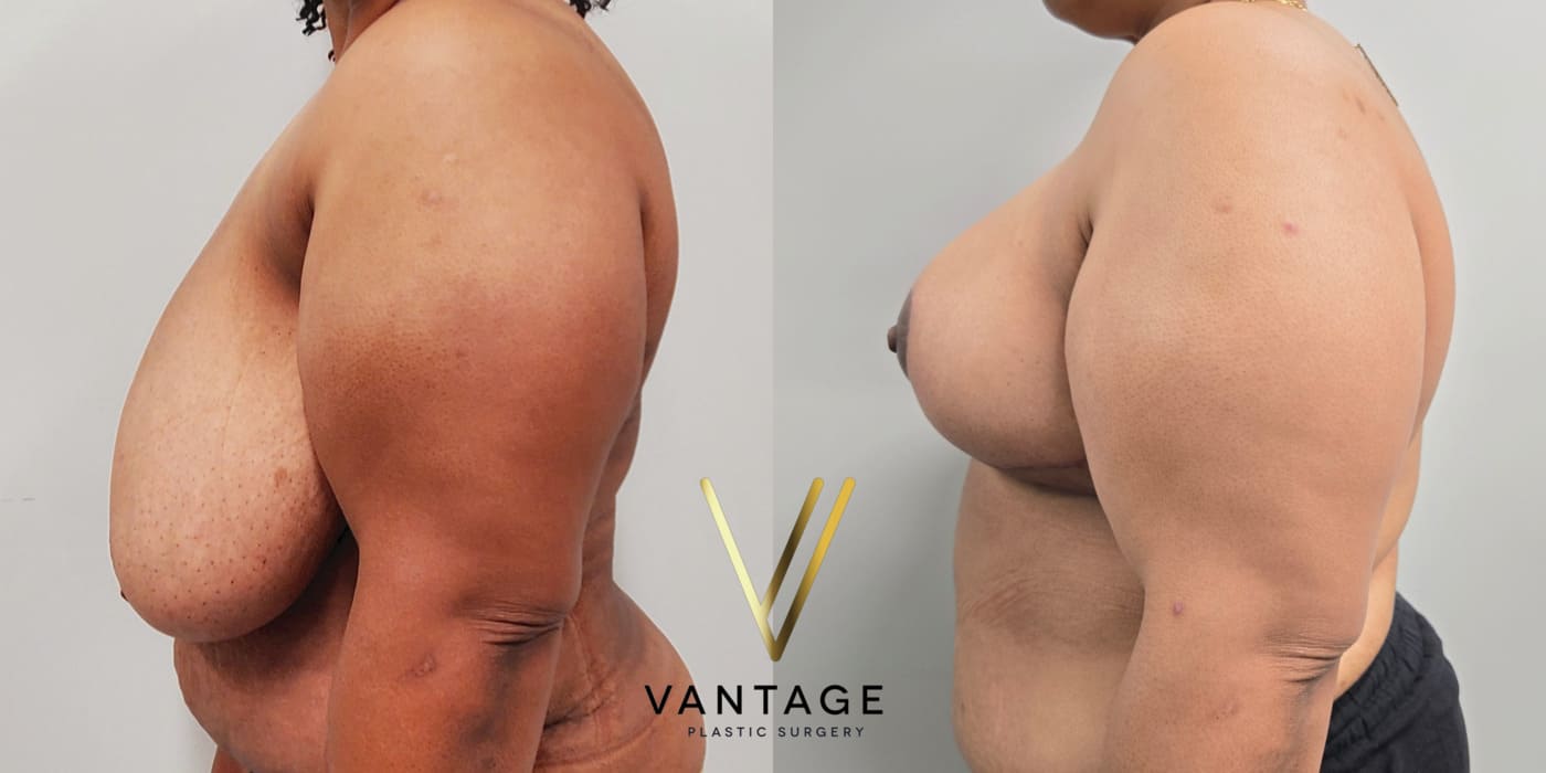 Before and after image of internal bra breast reduction procedure, left view, performed at Vantage Plastic Surgery.