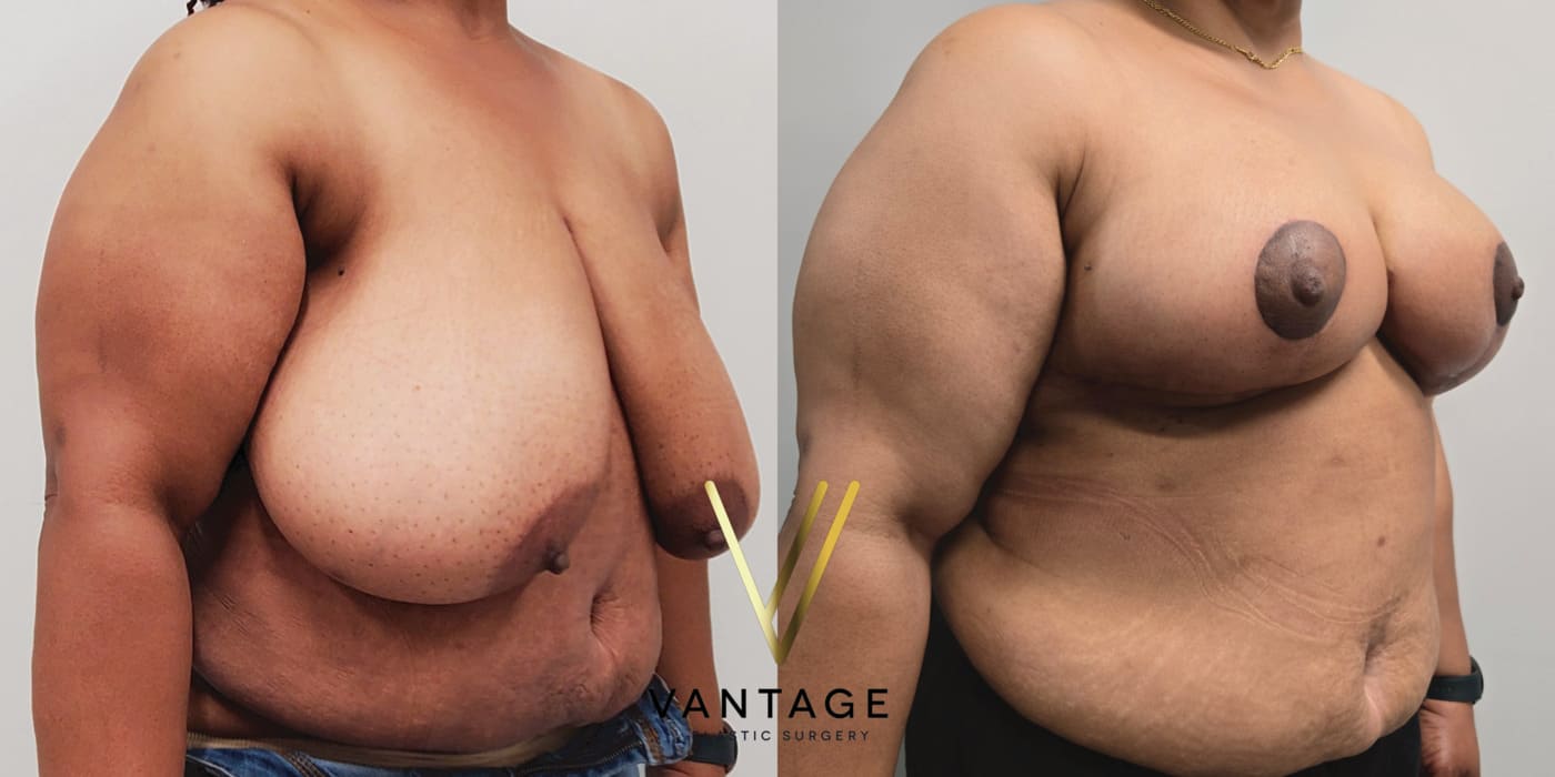 Before and after image of internal bra breast reduction procedure, right oblique view, performed at Vantage Plastic Surgery.