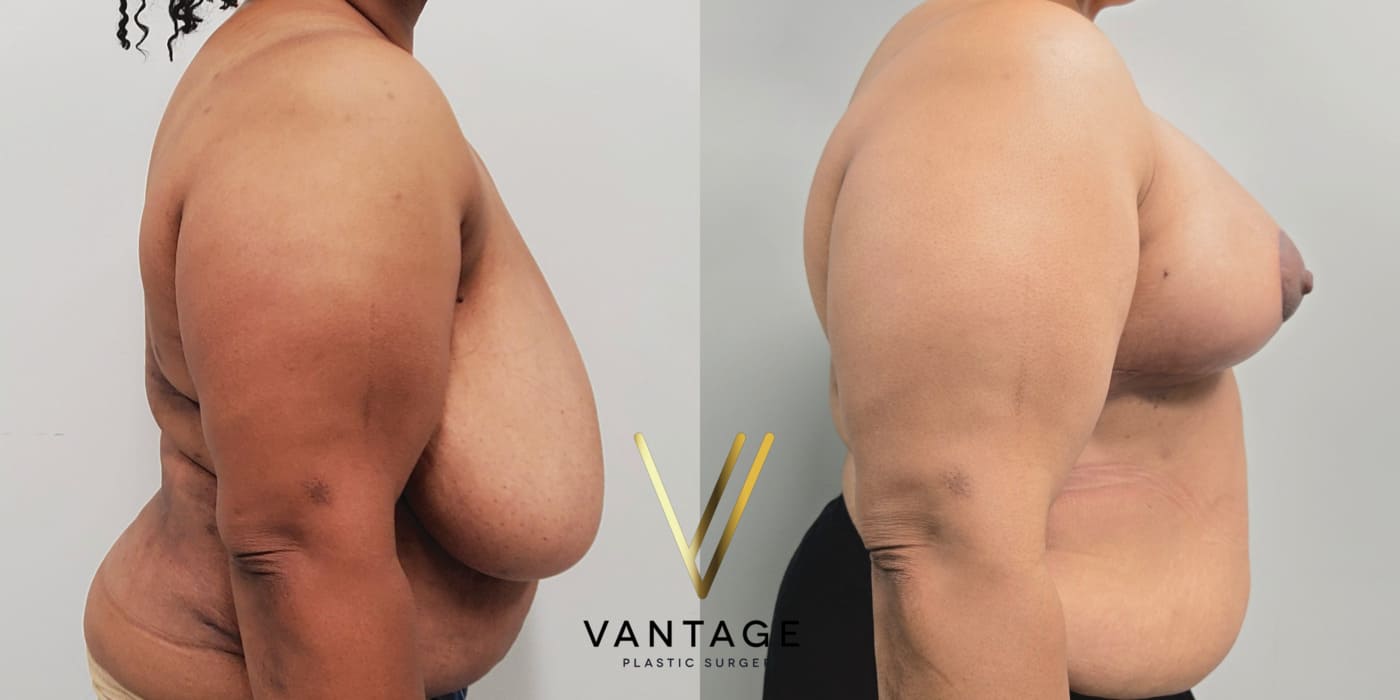 Before and after image of internal bra breast reduction procedure, right view, performed at Vantage Plastic Surgery.