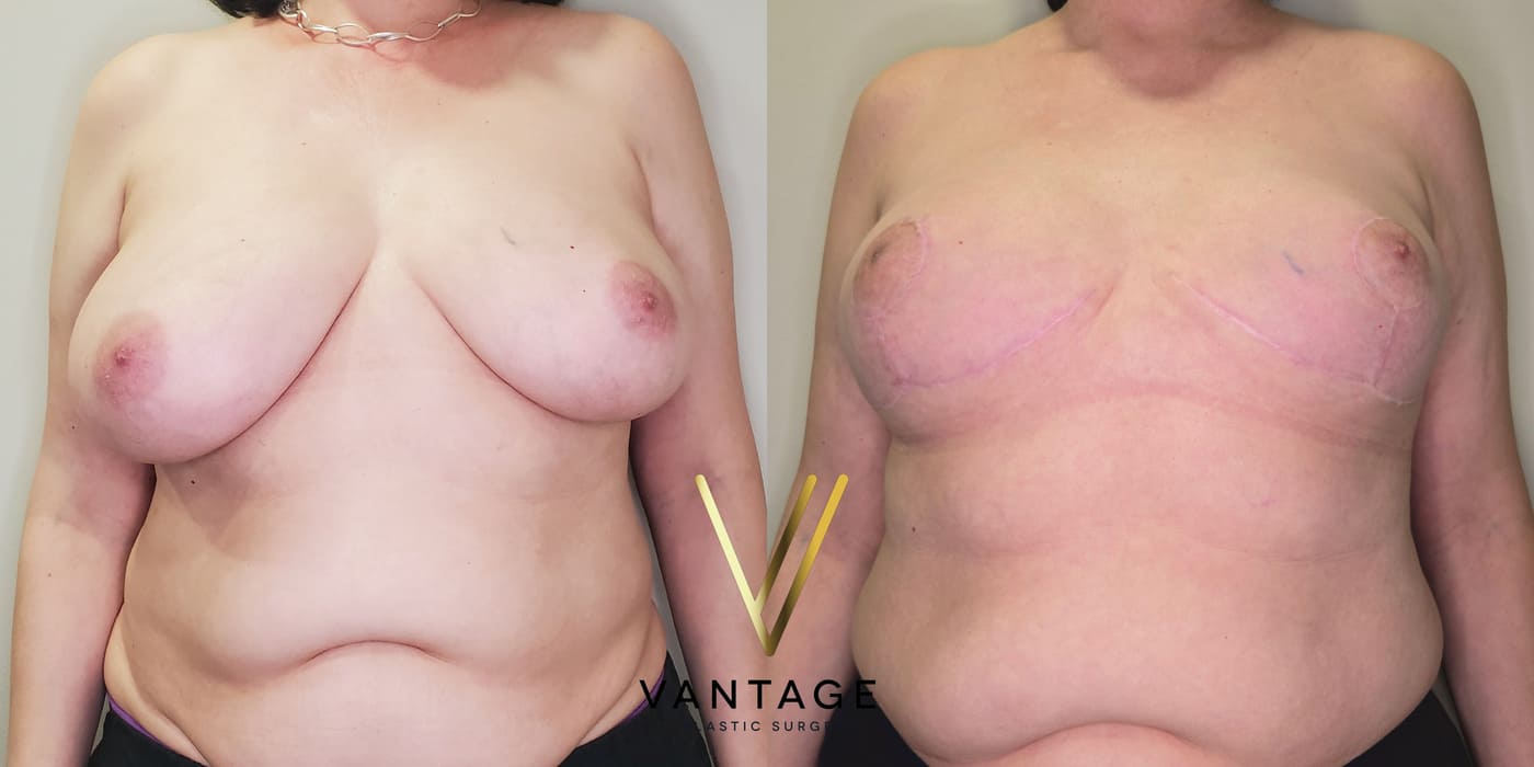 Before and after image of internal bra breast reduction procedure, front view, performed at Vantage Plastic Surgery.
