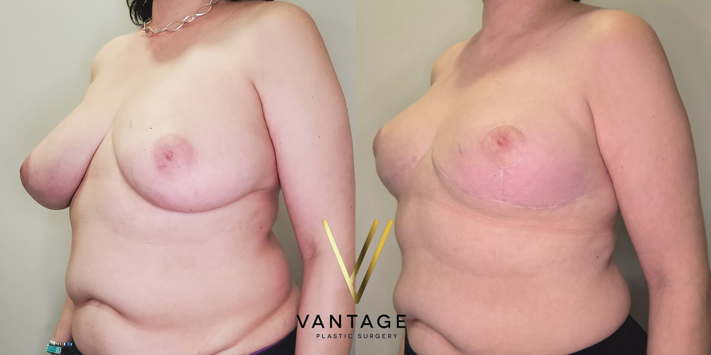 Before and after image of internal bra breast reduction procedure, left oblique view, performed at Vantage Plastic Surgery.