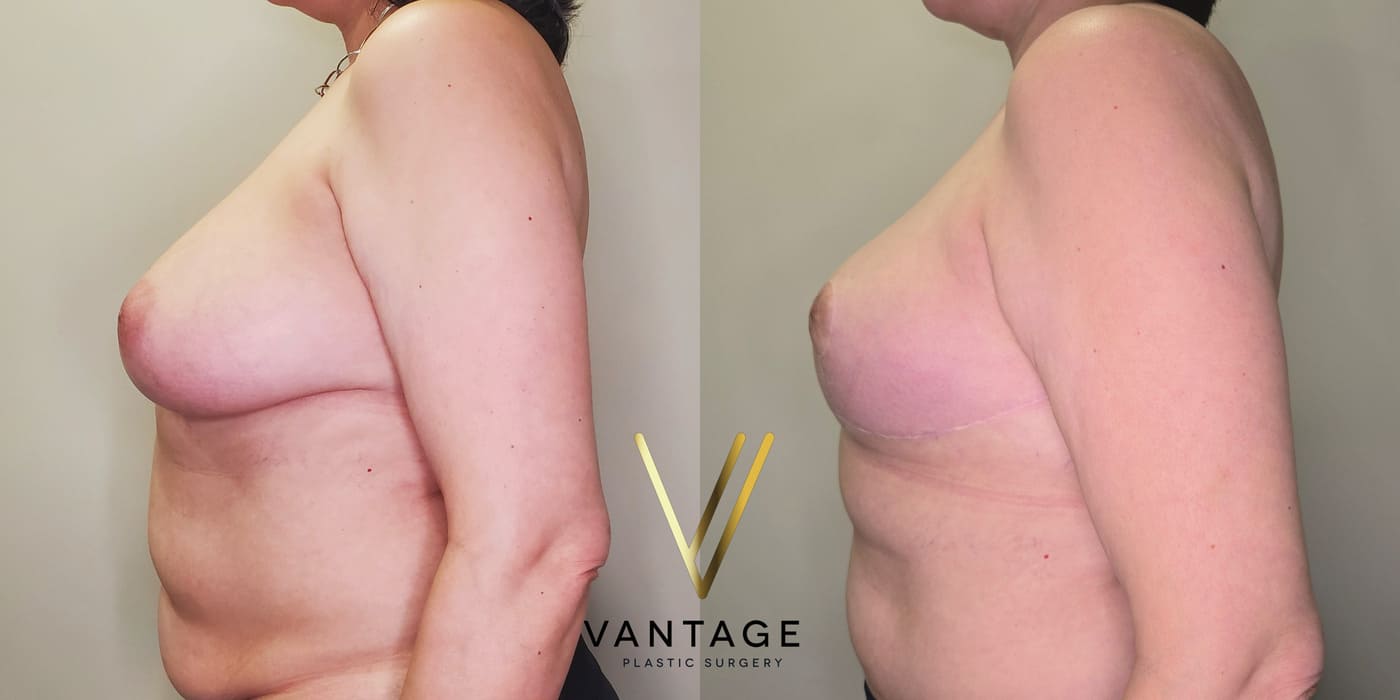 Before and after image of internal bra breast reduction procedure, left view, performed at Vantage Plastic Surgery.