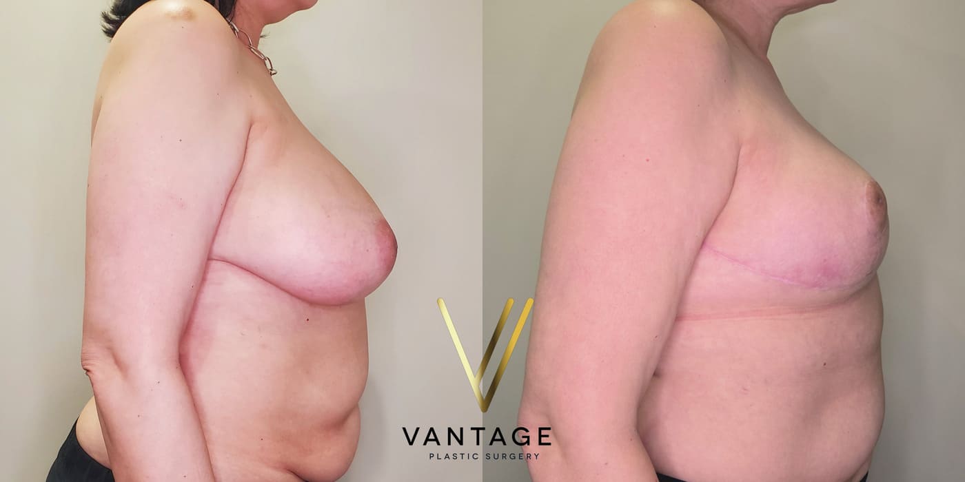 Before and after image of internal bra breast reduction procedure, right view, performed at Vantage Plastic Surgery.