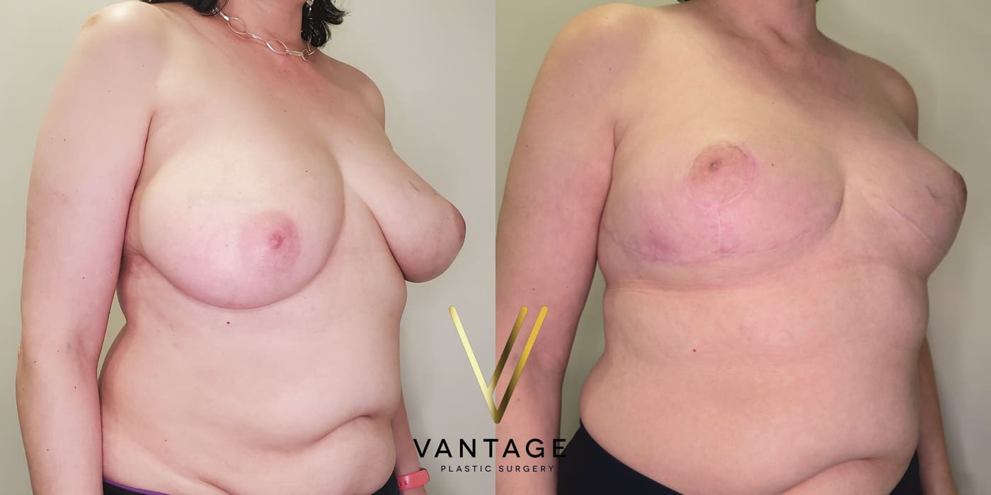 Before and after image of internal bra breast reduction procedure, right oblique view, performed at Vantage Plastic Surgery.