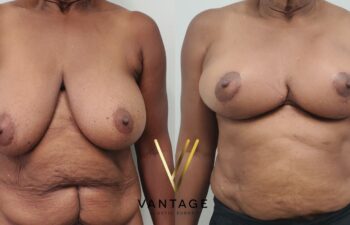 Before and after image of internal bra breast reduction procedure, front view, performed at Vantage Plastic Surgery.