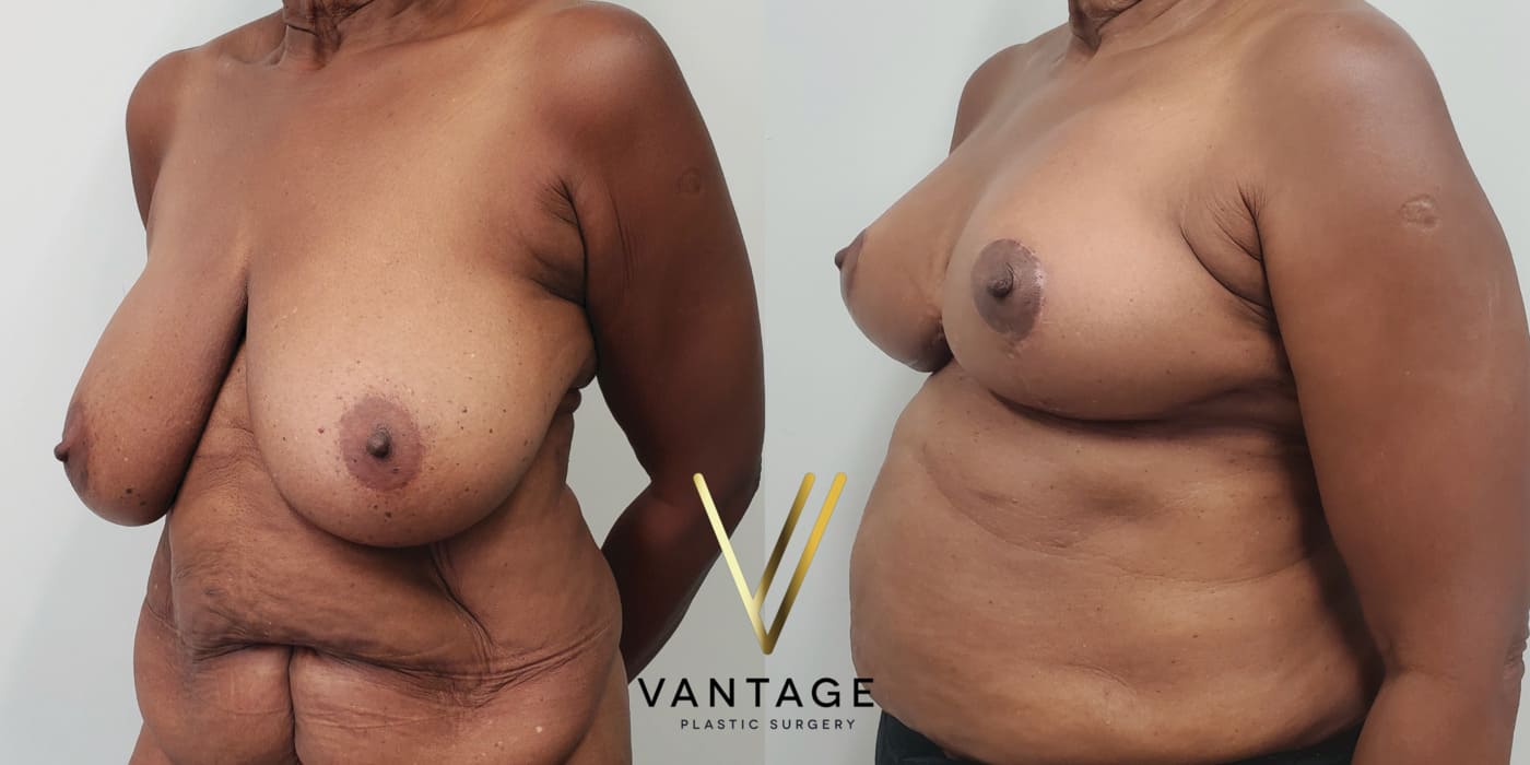 Before and after image of internal bra breast reduction procedure, left oblique view, performed at Vantage Plastic Surgery.