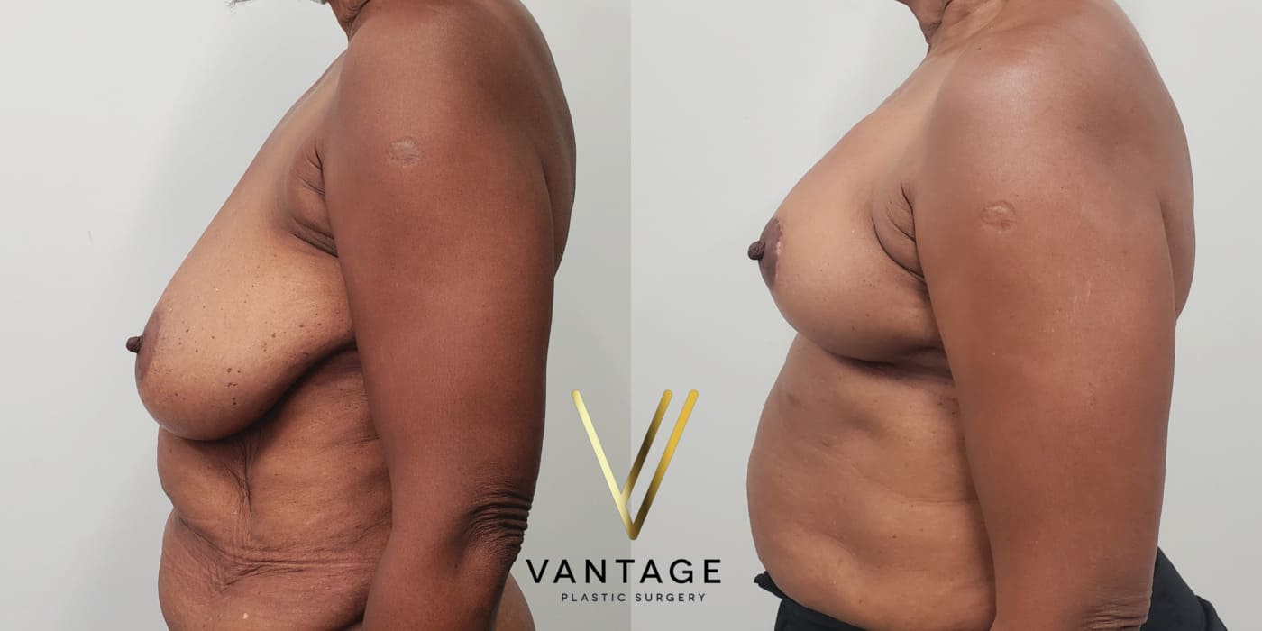 Before and after image of internal bra breast reduction procedure, left view, performed at Vantage Plastic Surgery.
